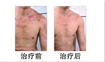 白癜风使我消沉，南通华医堂皮肤病医院让我生活信心百倍