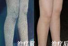 我的爱情不要阻碍---鱼鳞病治疗案例 我的爱情不要阻碍---鱼鳞病治疗案例
