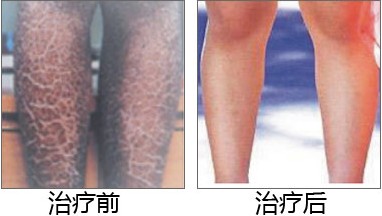 鱼鳞治疗成功病例