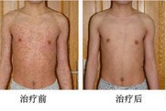 告别牛皮癣
