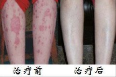 告别牛皮癣